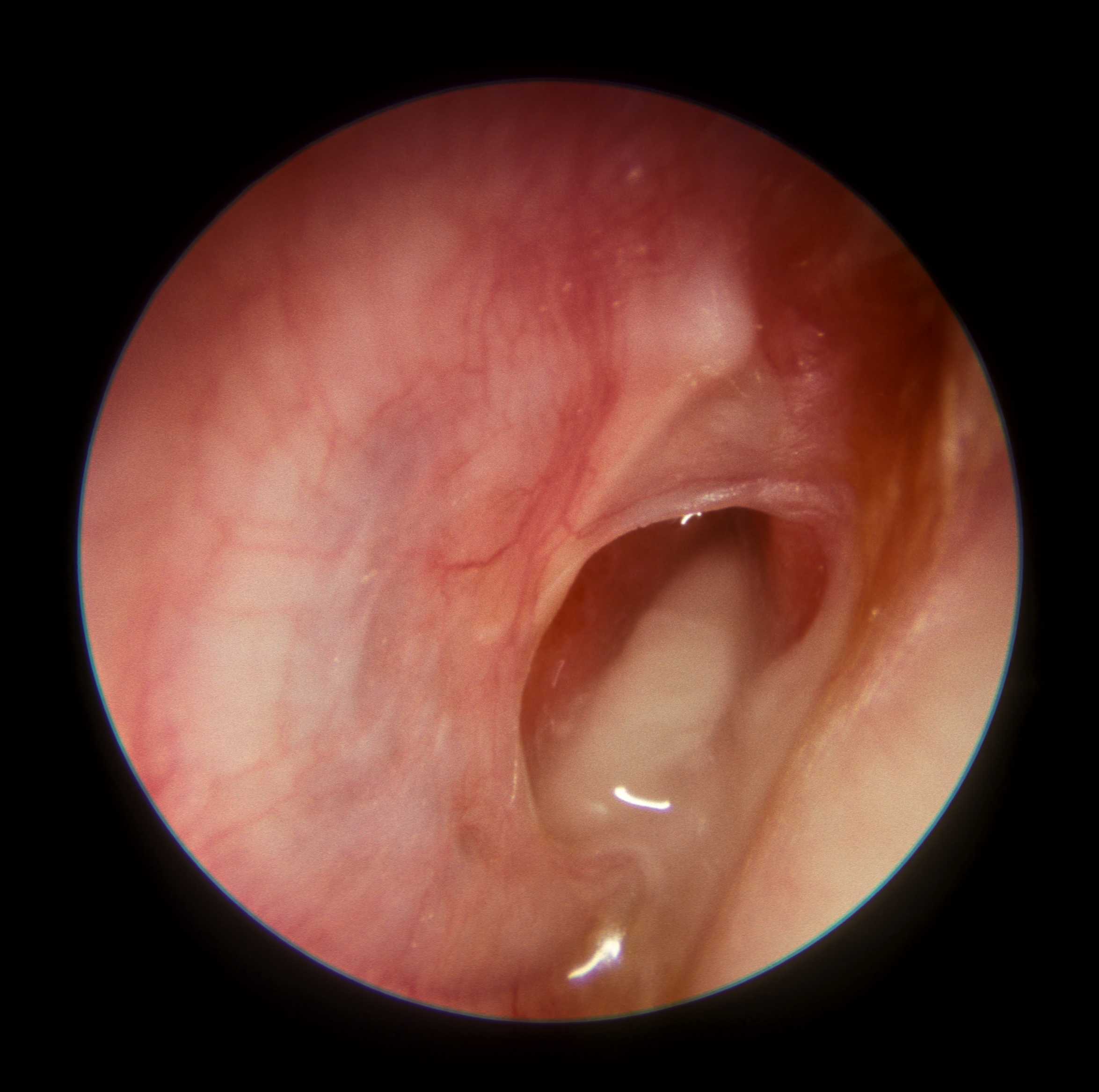 Otitis externa | NHG