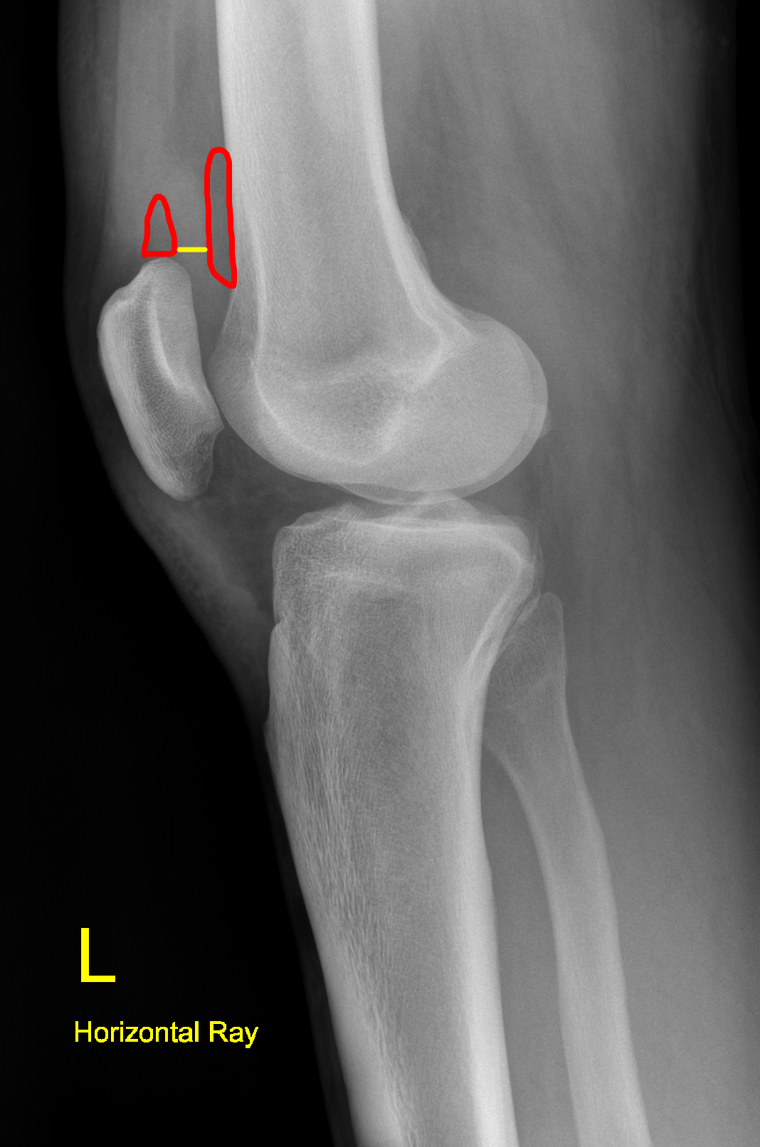 Knee X rays