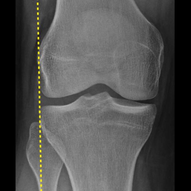 Knee X rays