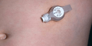 Gastrostomy Week Day 1 Why And When Don t Forget The Bubbles