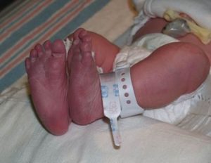 acrocyanosis
