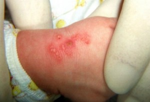 Neonatal Dermatology The Rashes You Shouldn T Ignore