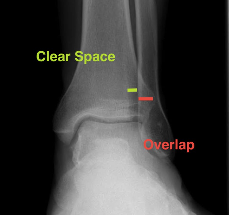 Ankle xrays