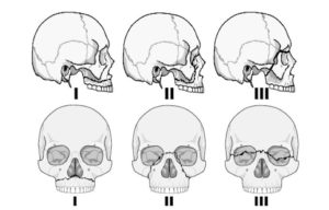 lefortclassification lefortclassification