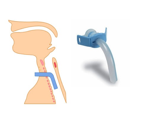 Crash course in tracheostomies - Don't Forget the Bubbles