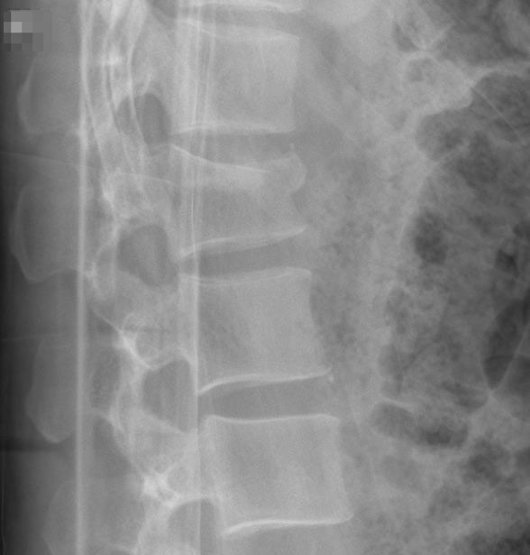 Thoracolumbar spine xrays