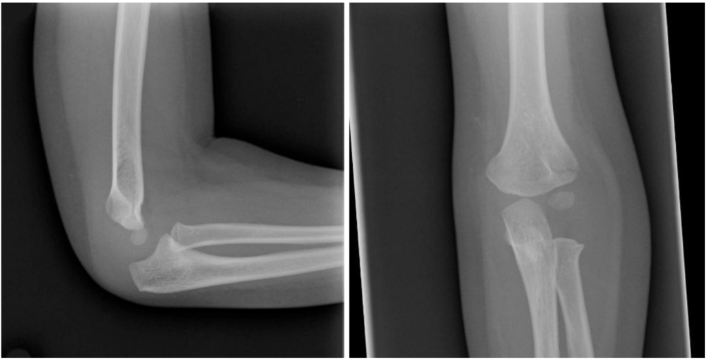 Elbow examination Don't the Bubbles