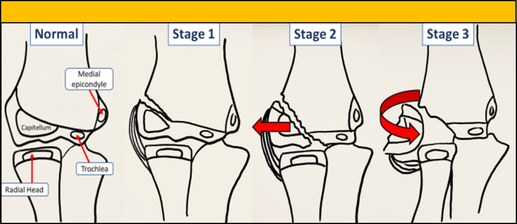 What Are The Classifications Of Condyle Fractures? – OCWKIJ