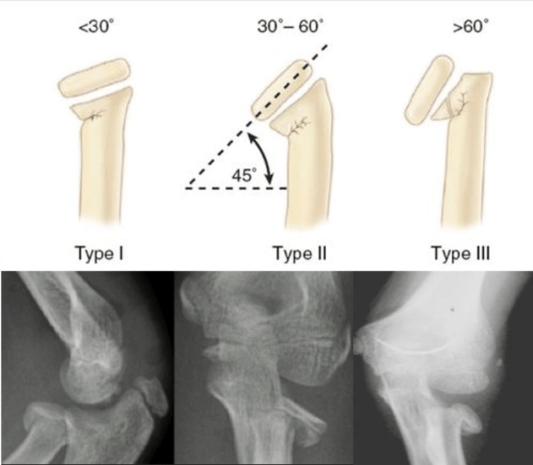Radial head and neck fractures