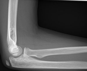 Olecranon fractures - Don't Forget the Bubbles