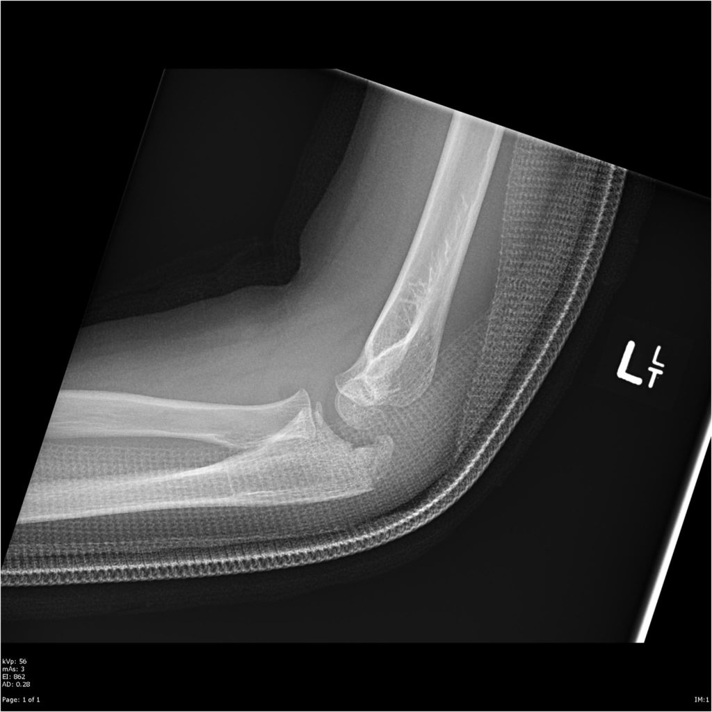 Olecranon fractures