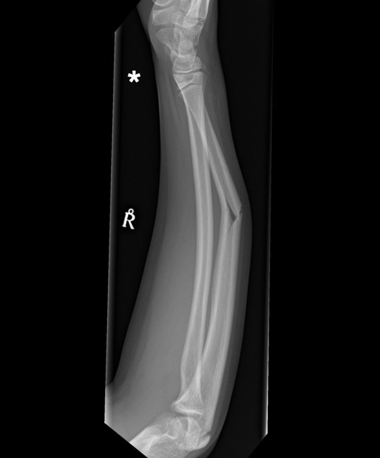 Midshaft radius and ulna fractures