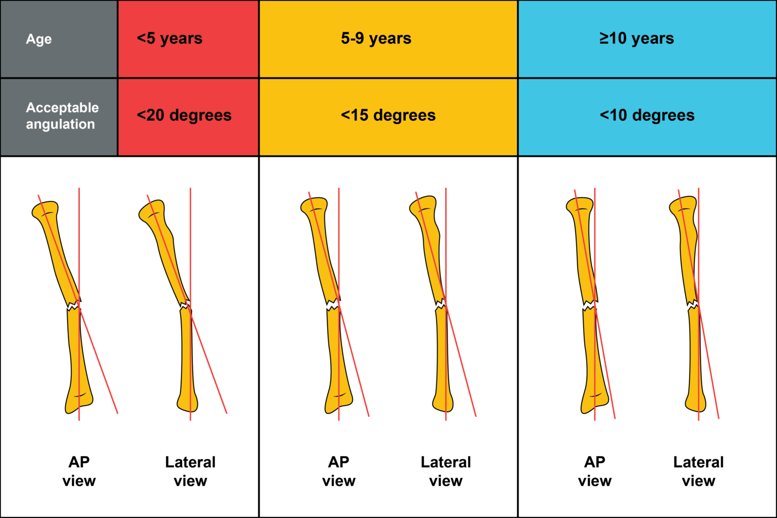 Radius And Ulna Shaft Fracture