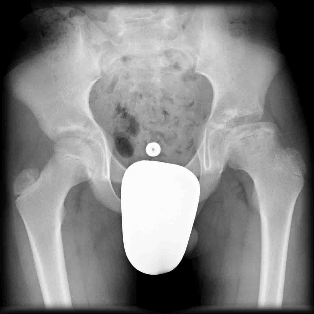 Osteochondrosis Don't the Bubbles