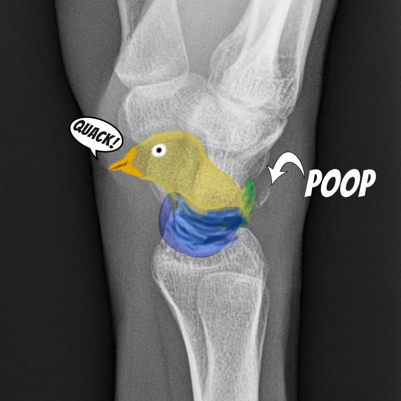 Pooping Duck Fracture GLJY Pooping Duck Fracture GLJY