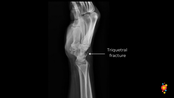 Carpal injuries - Don't Forget the Bubbles