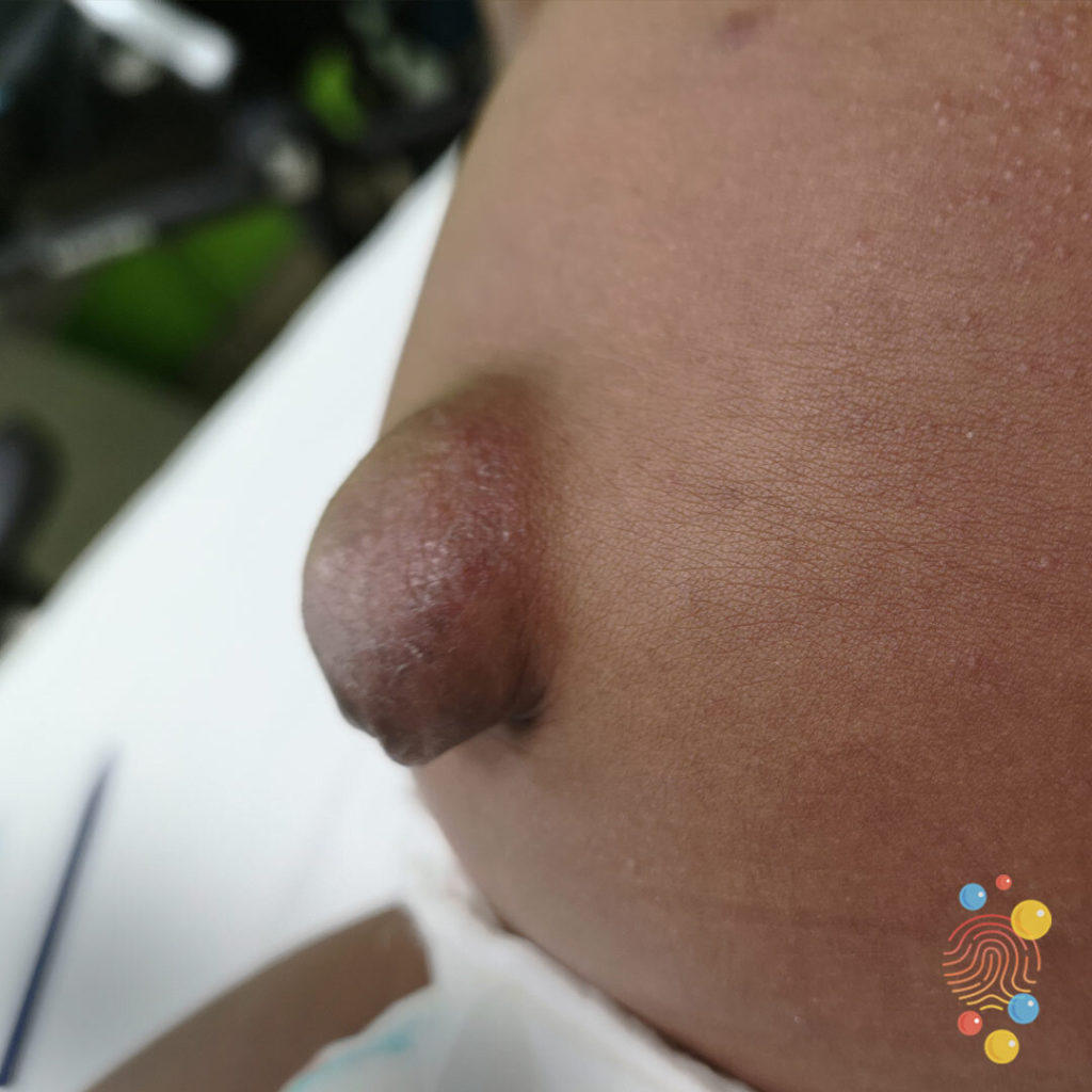 An umbilcal hernia