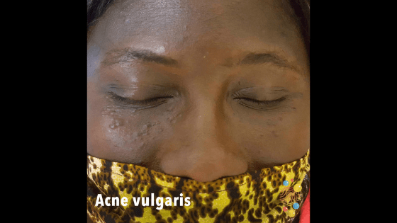 Acne vulgaris