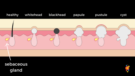 Aetiology of adolescent acne