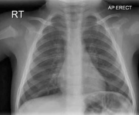 CXR of child with myocarditis