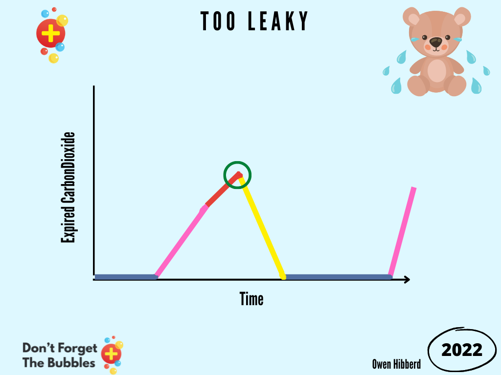 A picture of the capnography trace looks triangular if there is a cuff leak