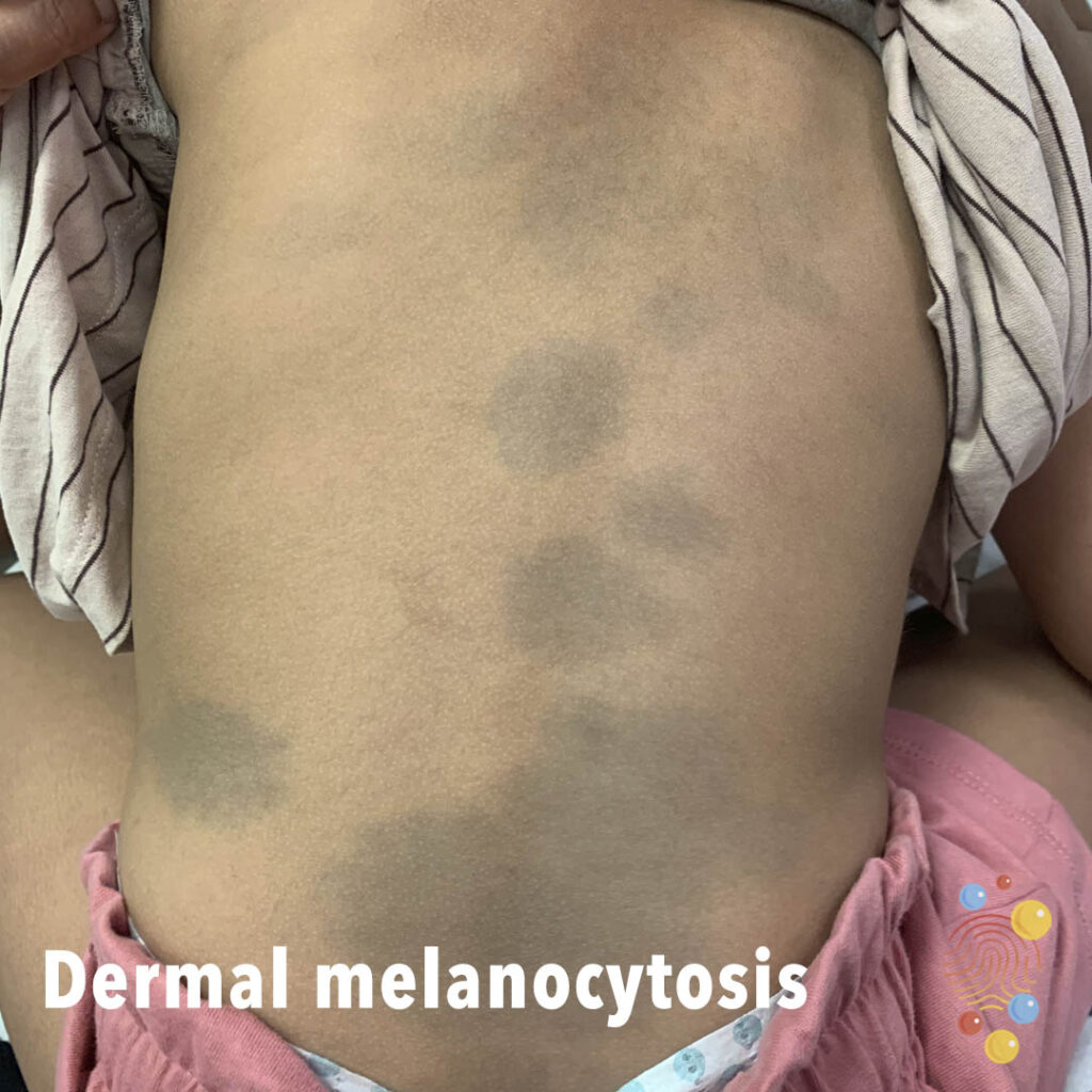 Benign neonatal dermatology of dermal melanocytosis - Flat, slate-gray to bluish-black, poorly circumscribed macules/patches