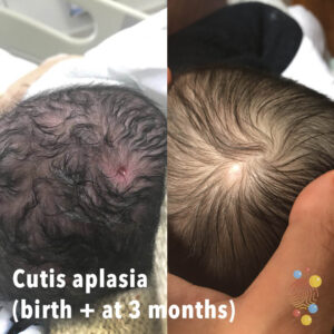 neonatal-dermatology-don-t-forget-the-bubbles