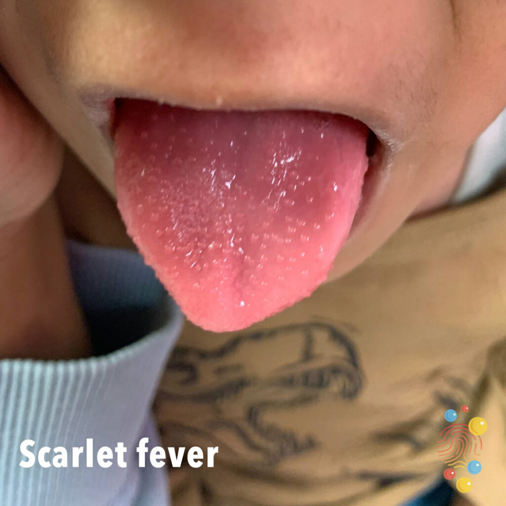 Scarlet Fever Don t Forget The Bubbles